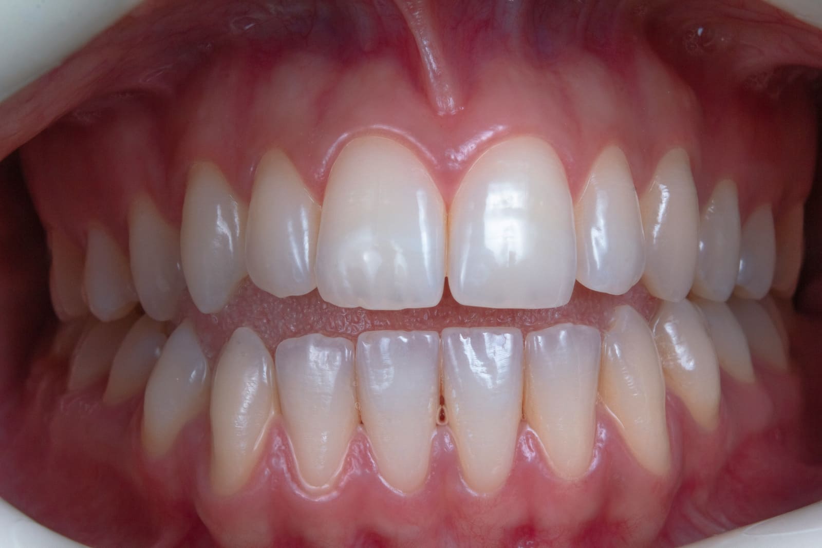 Sorriso claro e saudável após clareamento dental
