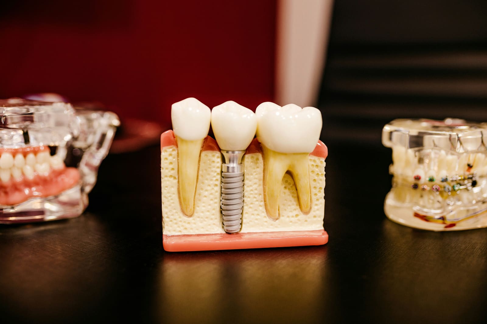 Modelo anatômico de implante dentário integrado ao osso